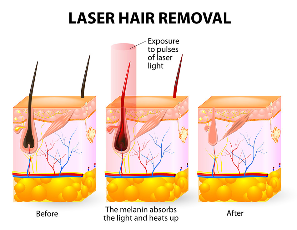 blog-diode-lasers-in-hair-removal.jpg Diode lasers deliver cosmetic benefits that are more than skin-deep
